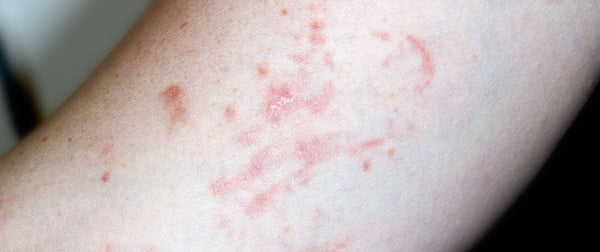 A START-TO-FINISH GUIDE TO PLAQUE PSORIASIS TREATMENT
