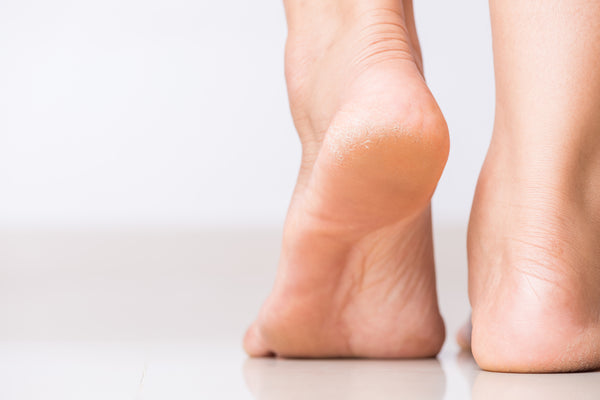 How To Treat Dry, Cracked Feet