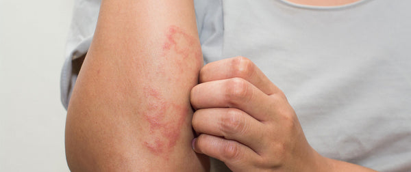 EVERYTHING YOU NEED TO KNOW ABOUT NUMMULAR ECZEMA TREATMENT