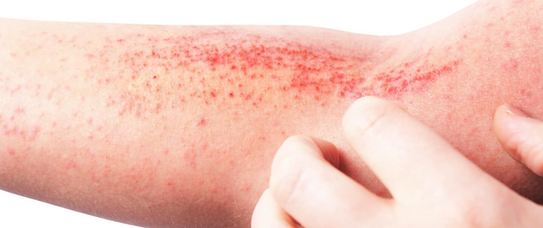 MISTAKES TO AVOID DURING CONTACT DERMATITIS TREATMENT