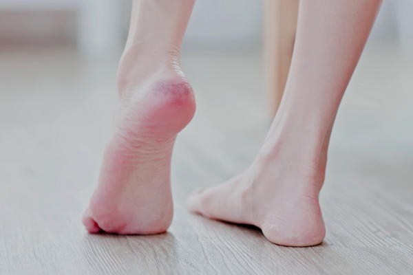 Cracked Heels and Vitamin Deficiency - Is There a Connection