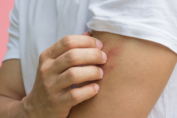 Does Psoriasis Spread?