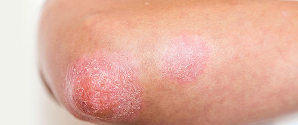 THE ADVANCED GUIDE TO GUTTATE PSORIASIS TREATMENT