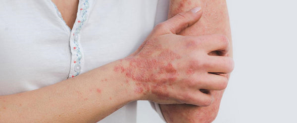 Solutions for People Suffering from Psoriasis