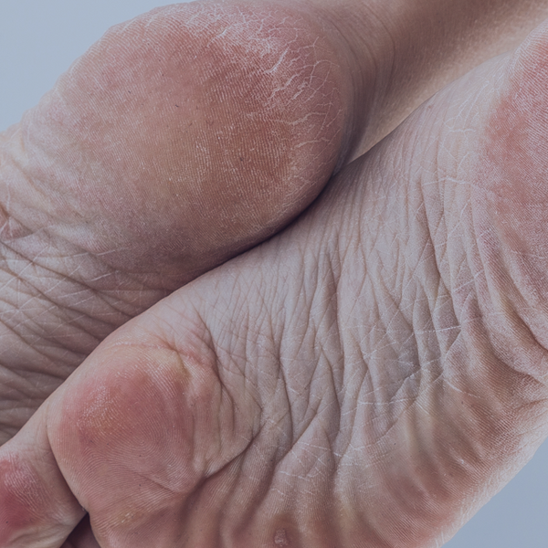 Dry cracked 2025 big toe