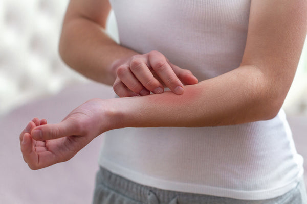 Plaque Psoriasis: How You Can Treat Cracks And Bleeding